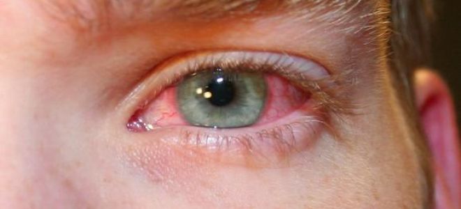 Опух глаз – что делать? все о проблеме и её решении здесь! – все о зрении