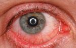 Повреждение глаз ультрафиолетом – все о зрении