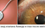 Клапан ахмеда – имплантация при глаукоме – все о зрении