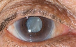 Как лечить глаукому – все о зрении
