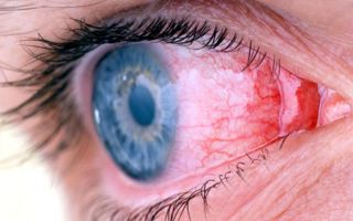 О воспалительных процессах в глазах и их лечении – все о зрении