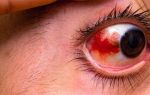 Красный глаз после удара – чем лечить – все о зрении