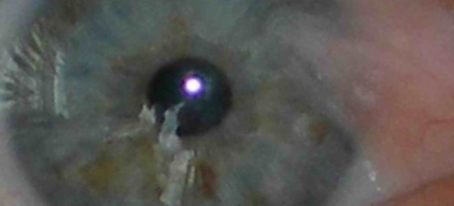 Деструкция стекловидного тела – все о зрении