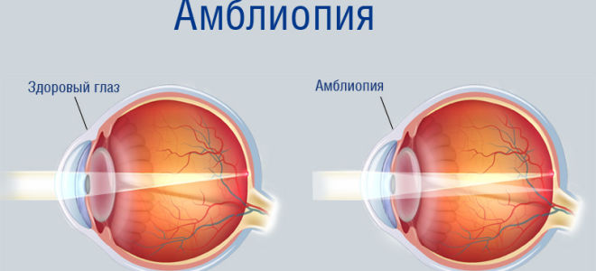 Энуклеация – все о зрении