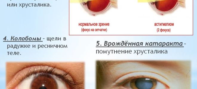 Миопический астигматизм: основные симптомы и лечение – все о зрении