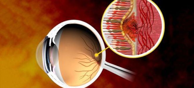 Найдено лекарство от возрастной макулярной дегенерации? – все о зрении