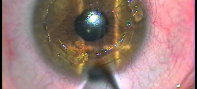 Фоторефракционная кератэктомия – все о зрении