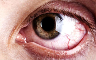 Рак глаза – все о зрении