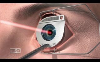 Лазерная коррекция зрения lasik – ход операции – все о зрении