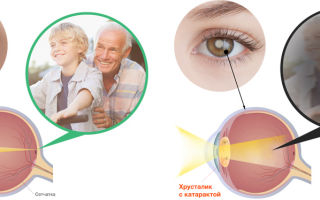 Лечение катаракты – все о зрении