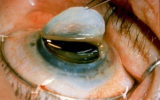 Кератопластика (пересадка роговицы глаза) в израиле – все о зрении