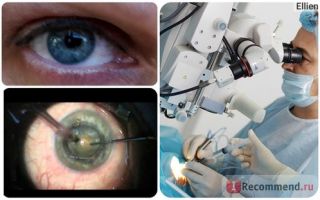 Осложнения операции по удалению катаракты – все о зрении