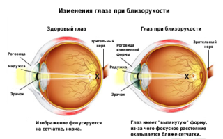 Изменения глаз при близорукости – все о зрении