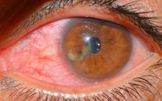 Поражение глаз при токсоплазмозе – все о зрении