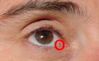 Злокачественная опухоль глаза: виды, симптомы, лечение – все о зрении