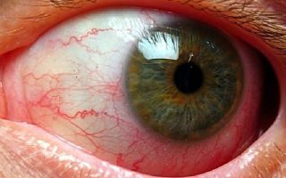 Ангиопатия сетчатки глаза у детей – все о зрении