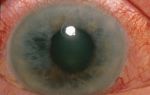 Применение статинов может вызвать развитие катаракты – все о зрении