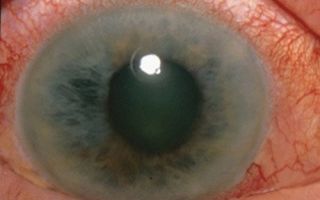 Применение статинов может вызвать развитие катаракты – все о зрении