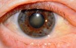Вторичная катаракта – все о зрении