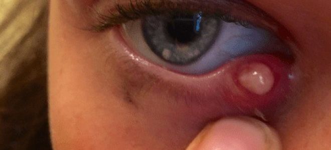 Ячмень на глазу – все о зрении