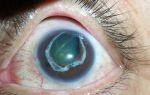 Первичная глаукома – все о зрении