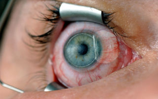 Как lasik, так и фрк приводят к формированию синдрома сухого глаза – все о зрении