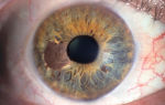 Онкология глаза – все о зрении