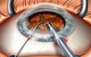 Лечение катаракты глаза без операции – все методы! – все о зрении