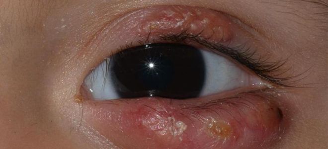 Халязион верхнего века – все о зрении