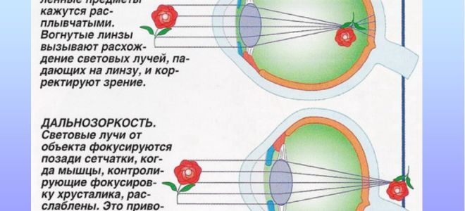 Миопия и спорт: особенности занятия спортом при близорукости и дальнозоркости – все о зрении
