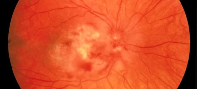 Хориоретинит – все о зрении