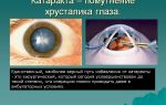 Что такое катаракта – все о зрении