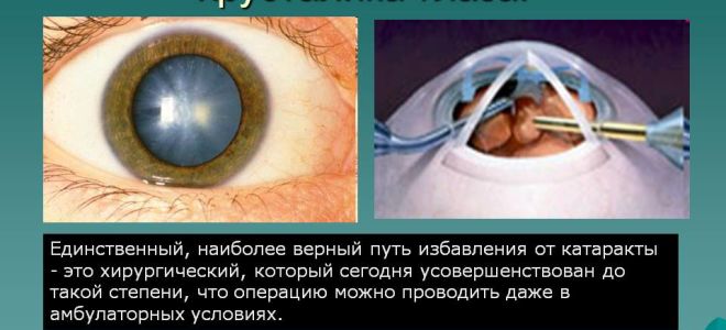 Что такое катаракта – все о зрении