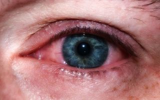 Избыток углеводов и корковая катаракта – все о зрении