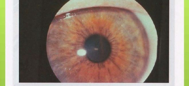 Синдром пигментной дисперсии – все о зрении