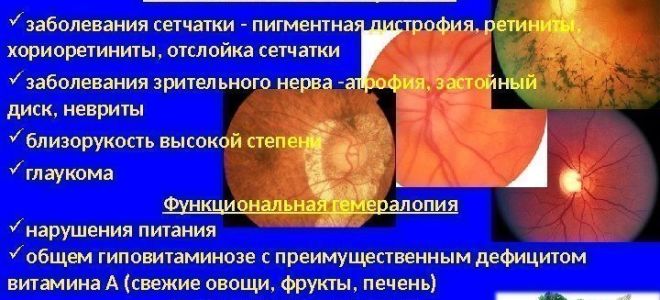 Нарушение сумеречного зрения – все о зрении