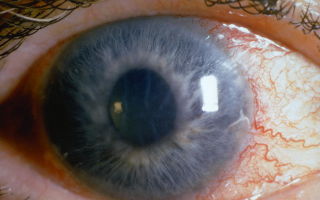 Открытоугольная глаукома – все о зрении