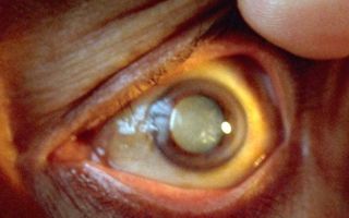 Для лечения глазных болезней будут использовать донорские клетки – все о зрении