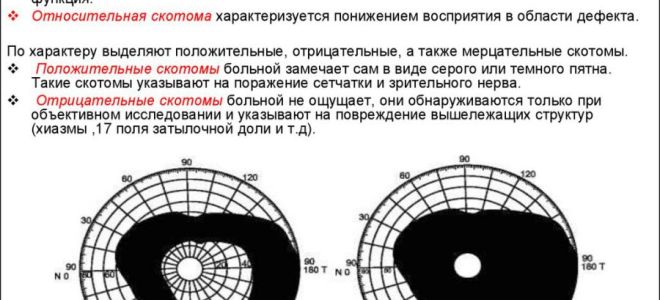 Скотома – все о зрении