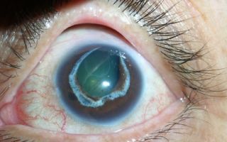 Глаукома может быть обнаружена за 10 лет до проявления симптомов – все о зрении