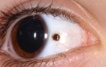 Меланоз глаз (меланопатия) – все о зрении