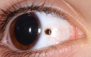 Меланоз глаз (меланопатия) – все о зрении