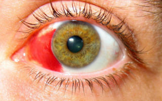 Красные белки глаз – что делать? – все о зрении