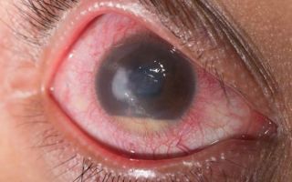Вторичная глаукома – все о зрении