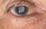 Операция по поводу катаракты улучшает когнитивные функции – все о зрении