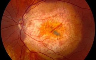 Диабетическая ретинопатия – все о зрении