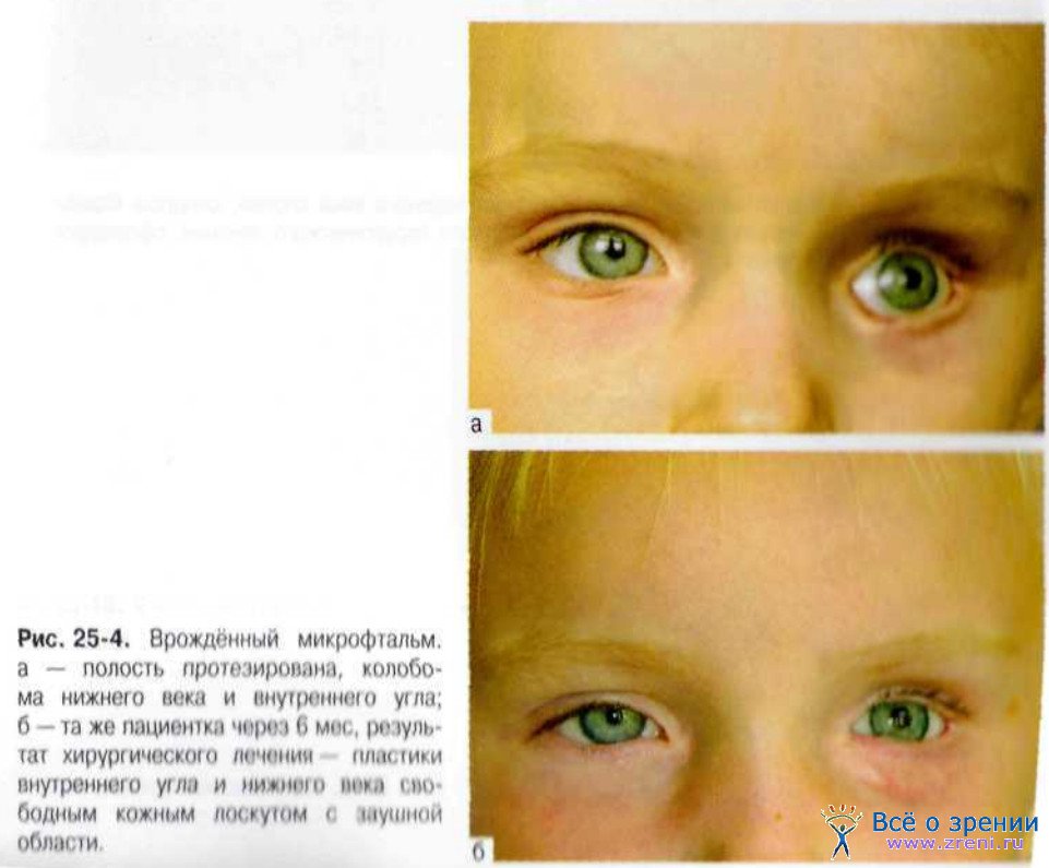 Анофтальм. Врожденная патология микрофтальм. Врожденное отсутствие глазных яблок.