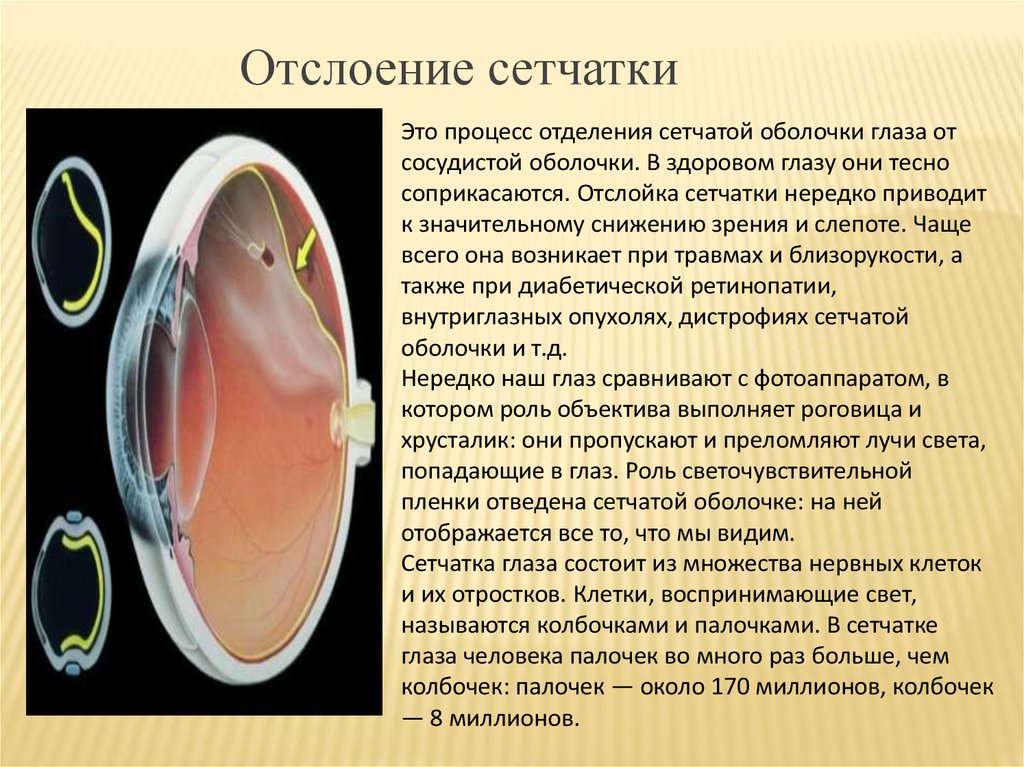 Отслойка сетчатки причины. Отслойка сетчатки глаза симптомы. Назовите основные методы лечения отслойки сетчатки..