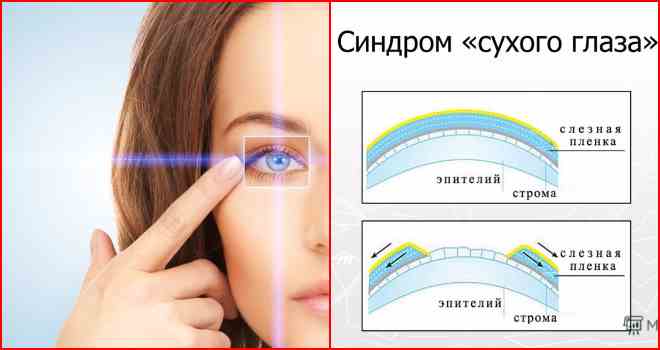 Причины симптома сухого глаза. Синдром сухого глаза памятка. Синдром сухого глаза симптомы. Слезная пленка.