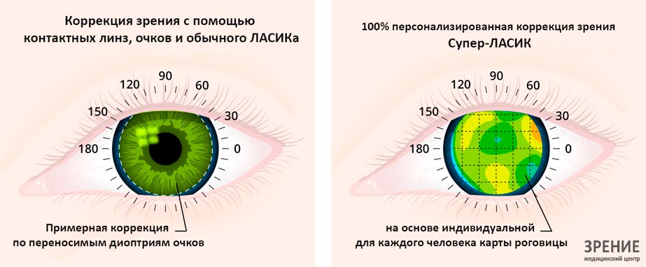 Как долго восстанавливается зрение. Лазерная коррекция зрения методом ФРК. LASIK лазерный кератомилез. Метод ластика в коррекции зрения. Глаза после лазерной коррекции.